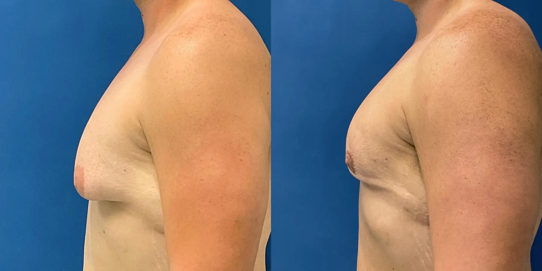 Male Breast Reduction: Patient 13 - Before and After 4