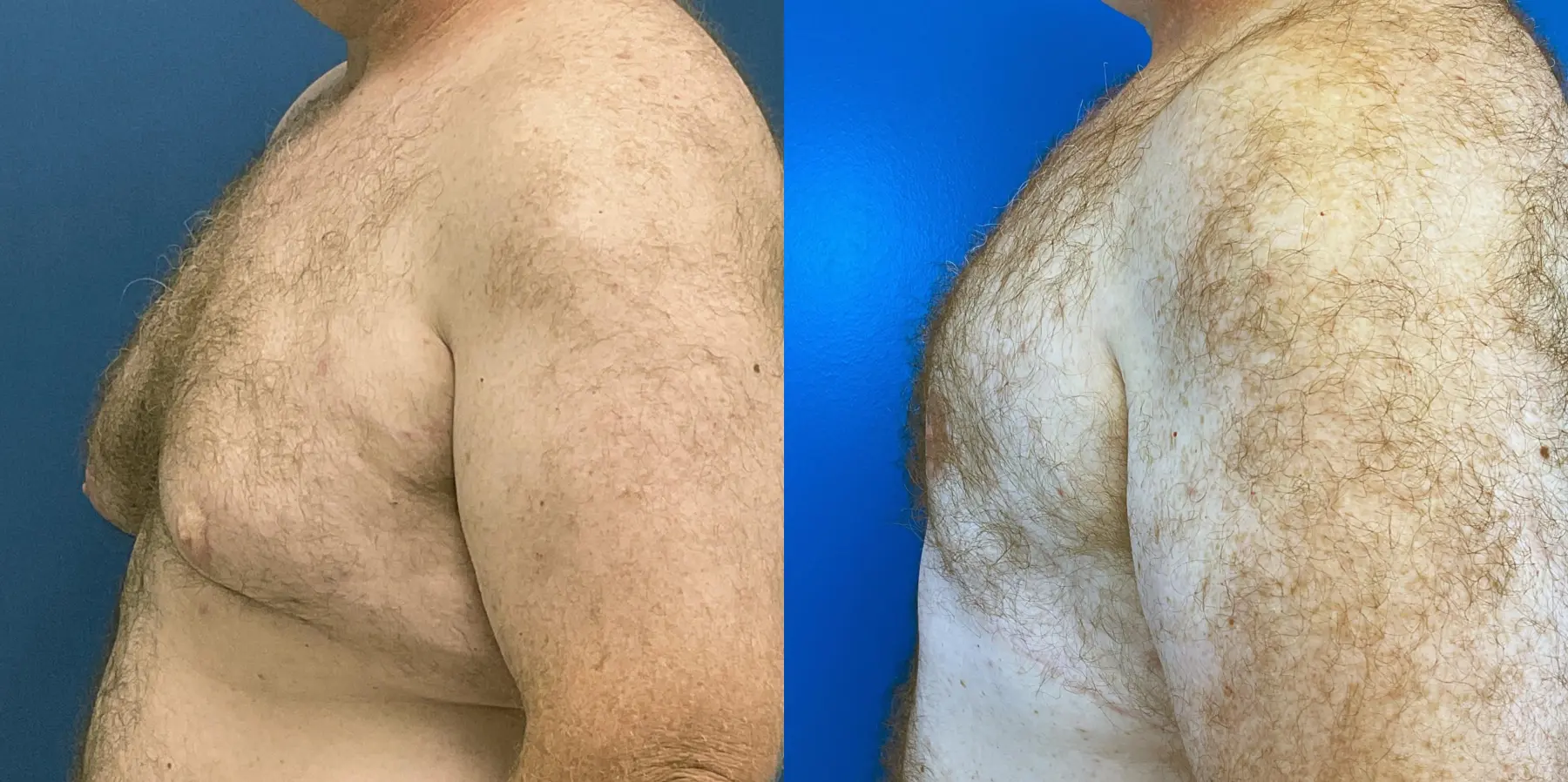 Male Breast Reduction: Patient 9 - Before and After 4