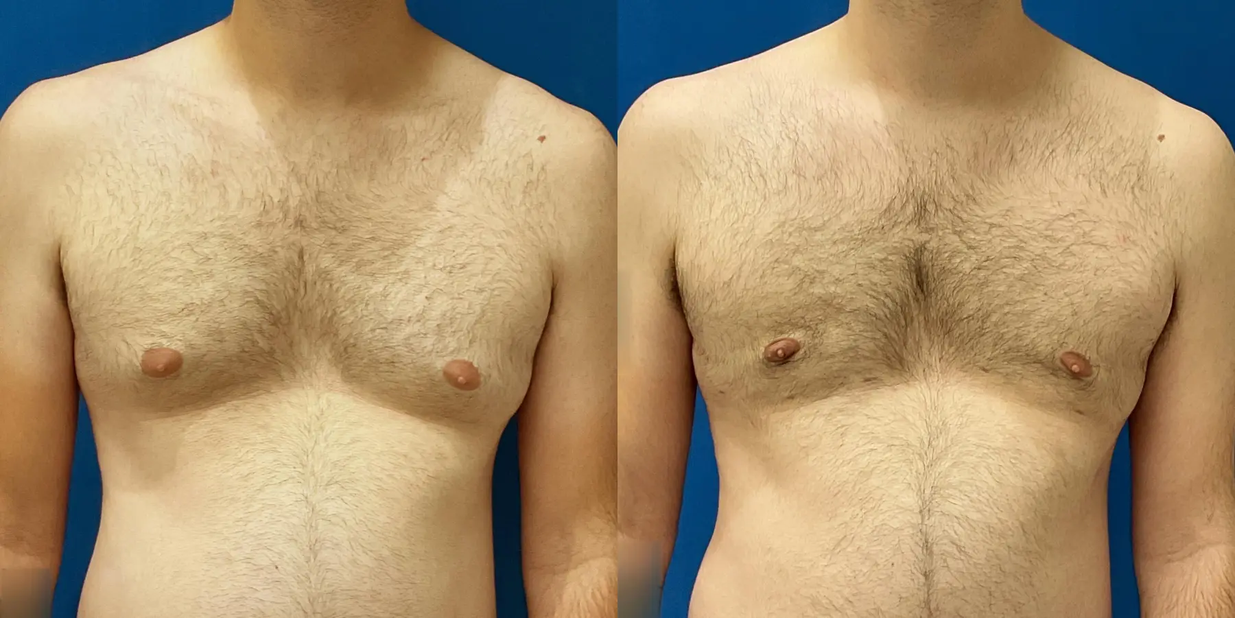 Male Breast Reduction: Patient 12 - Before and After 1