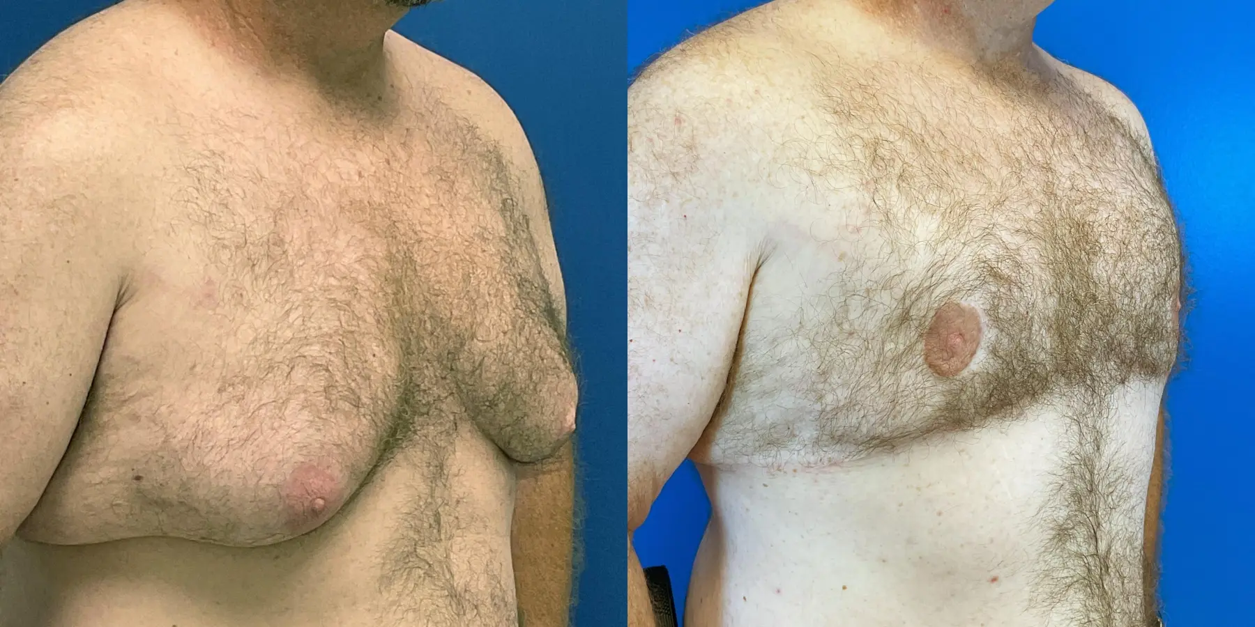 Male Breast Reduction: Patient 9 - Before and After 3