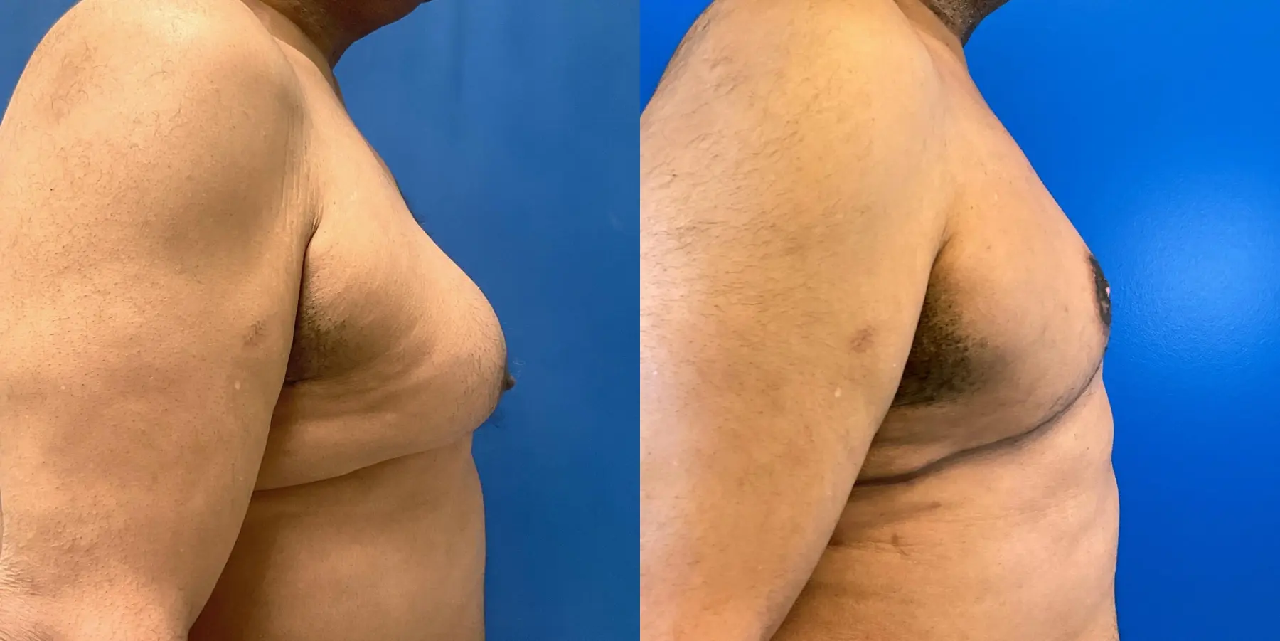 Male Breast Reduction: Patient 2 - Before and After 5