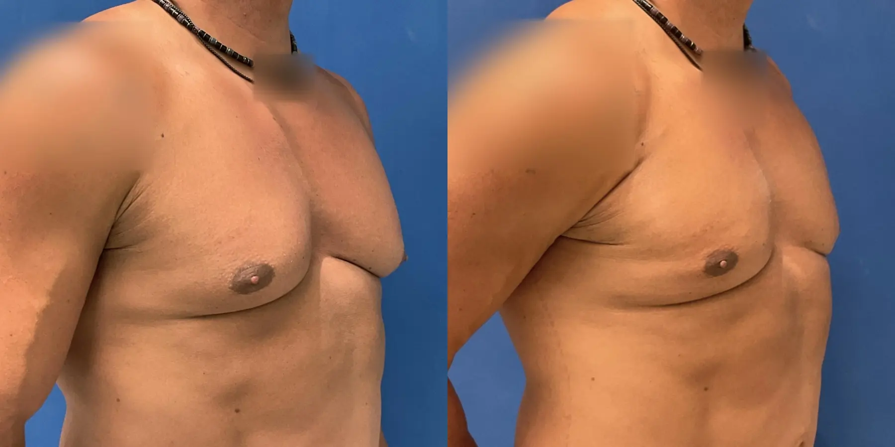 Male Breast Reduction: Patient 4 - Before and After 3