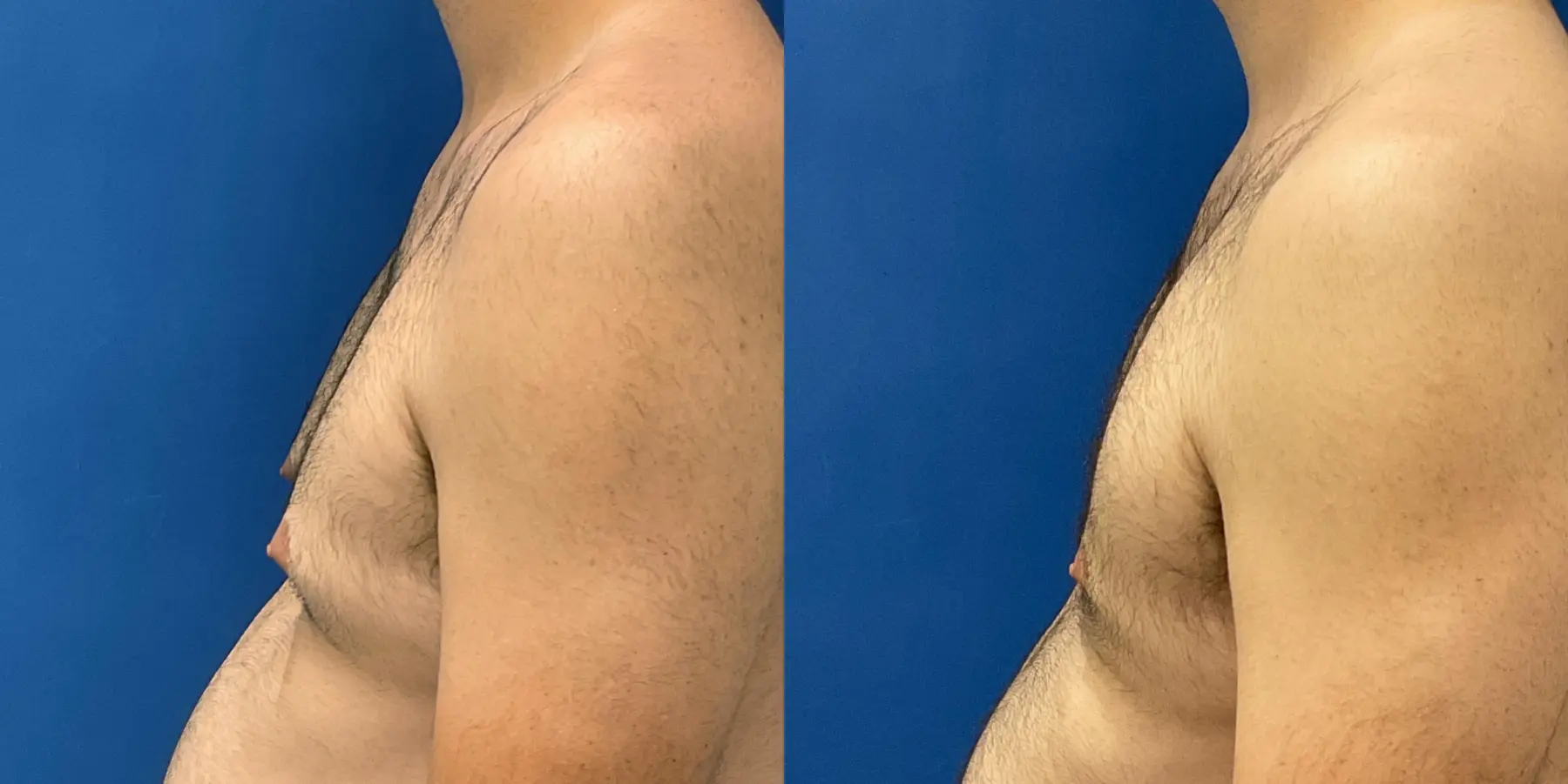 Male Breast Reduction: Patient 12 - Before and After 4