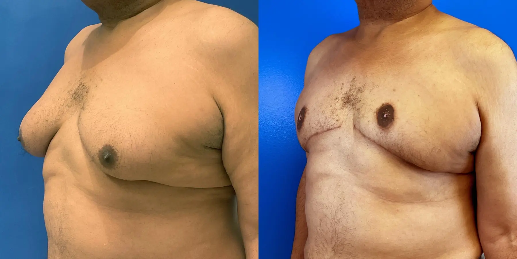 Male Breast Reduction: Patient 8 - Before and After 2