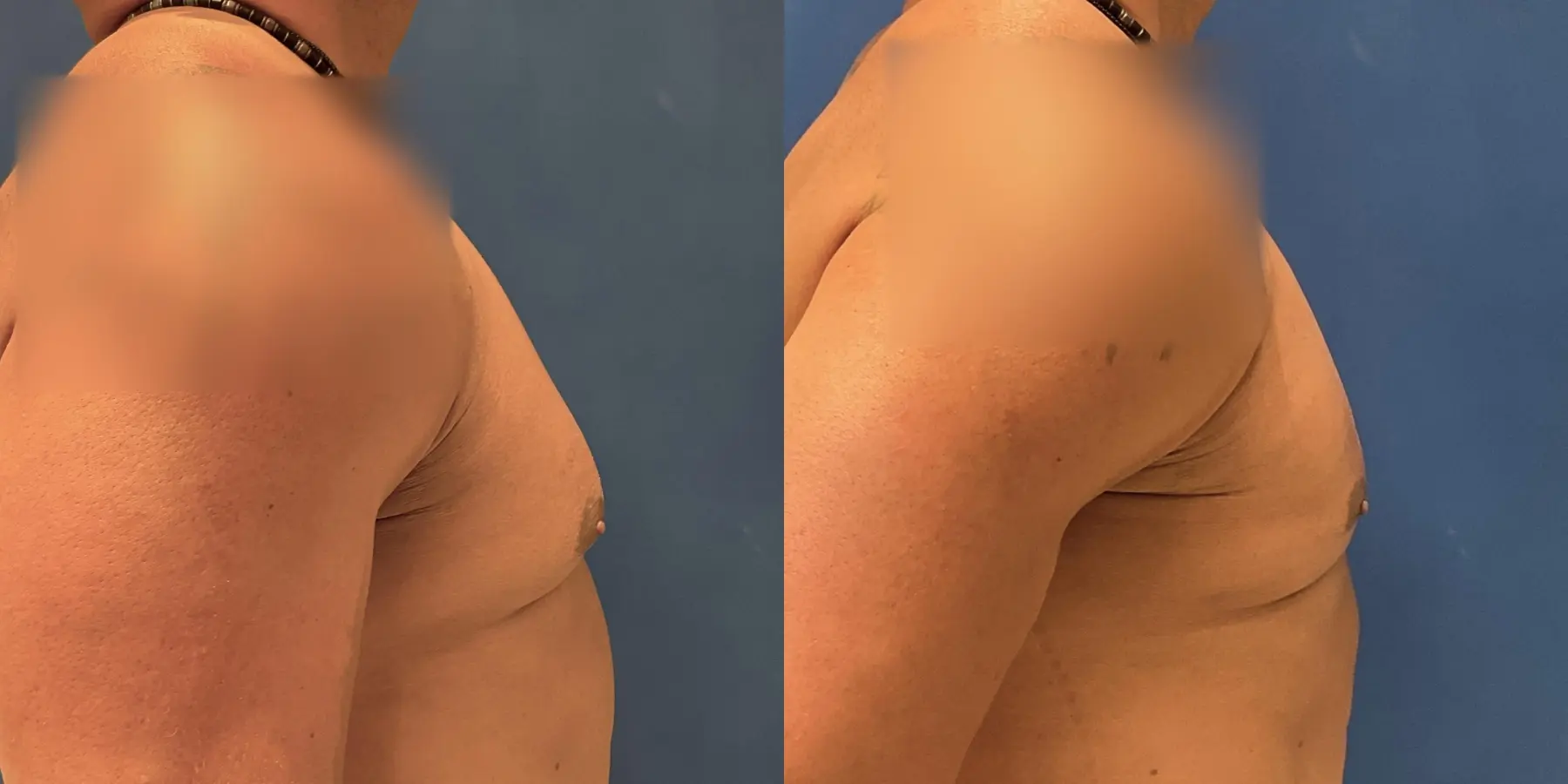 Renuvion For Men: Patient 2 - Before and After 5