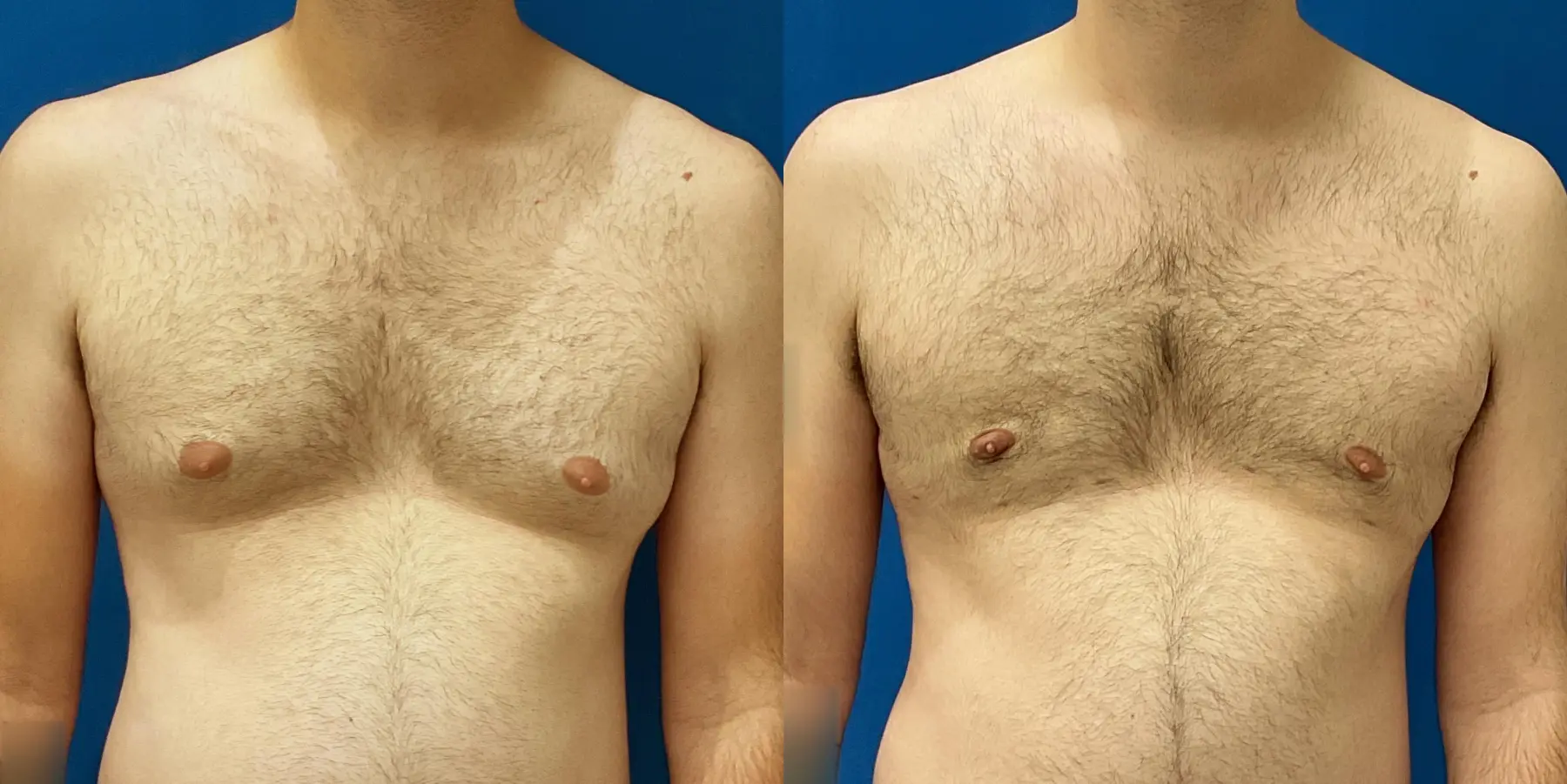 Renuvion For Men: Patient 3 - Before and After 1