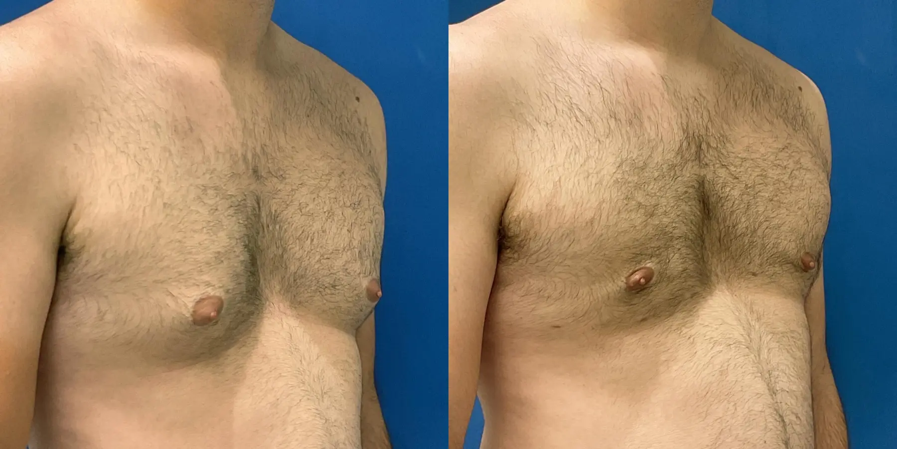 Renuvion For Men: Patient 3 - Before and After 3