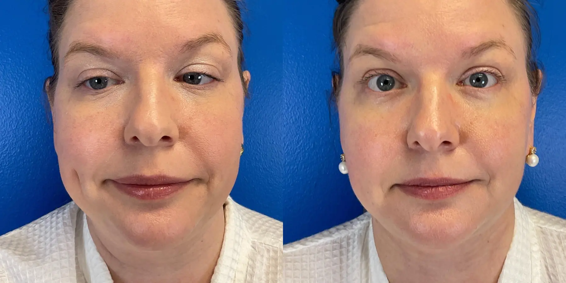 Renuvion Face: Patient 3 - Before and After 3