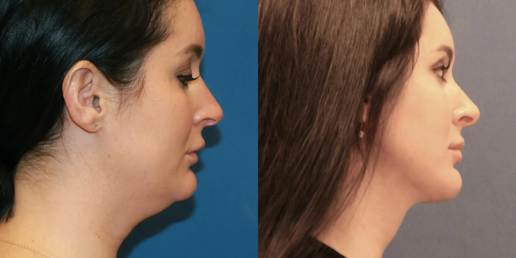 Renuvion Face: Patient 1 - Before and After  