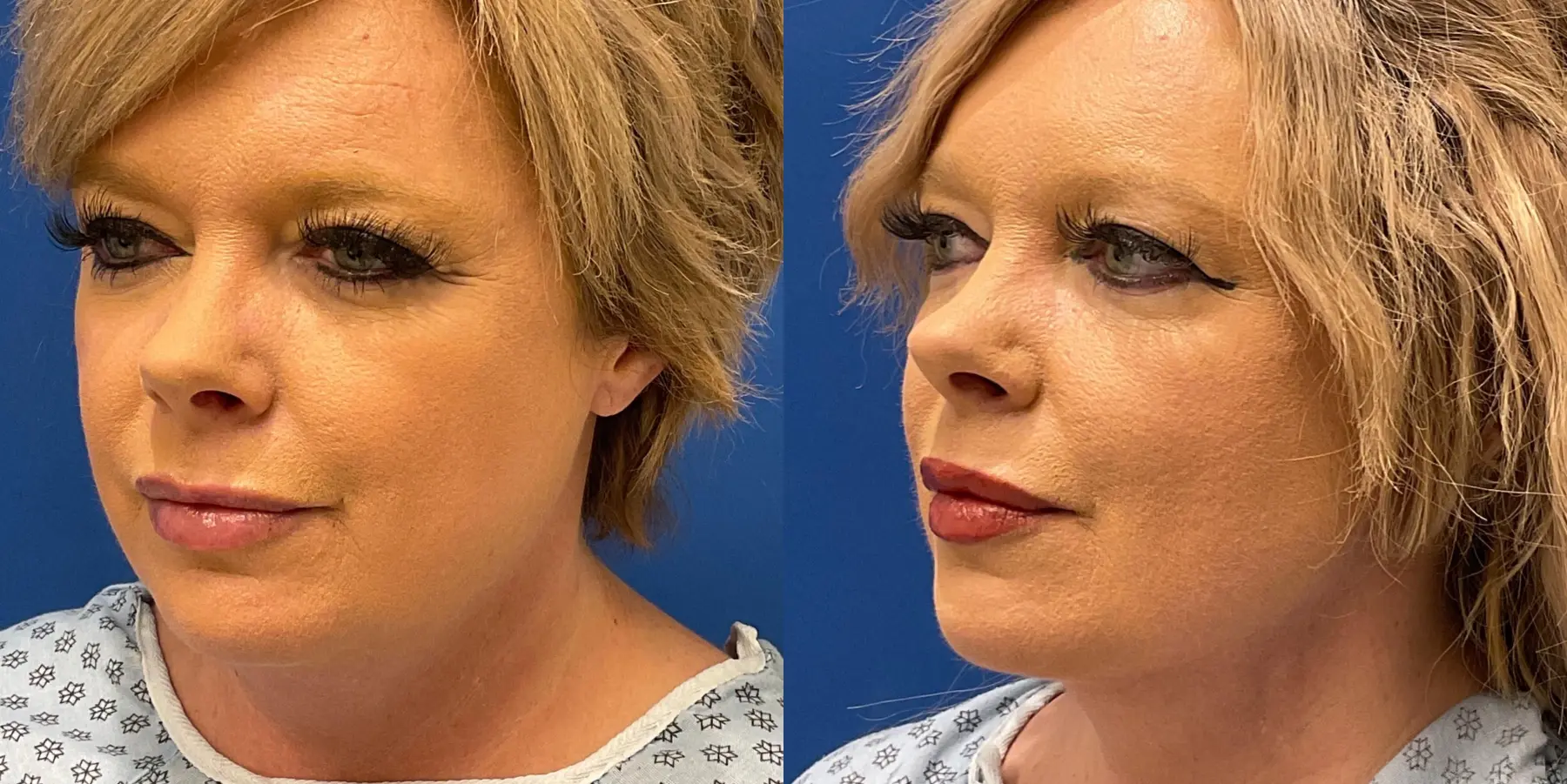 Renuvion Face: Patient 2 - Before and After 4