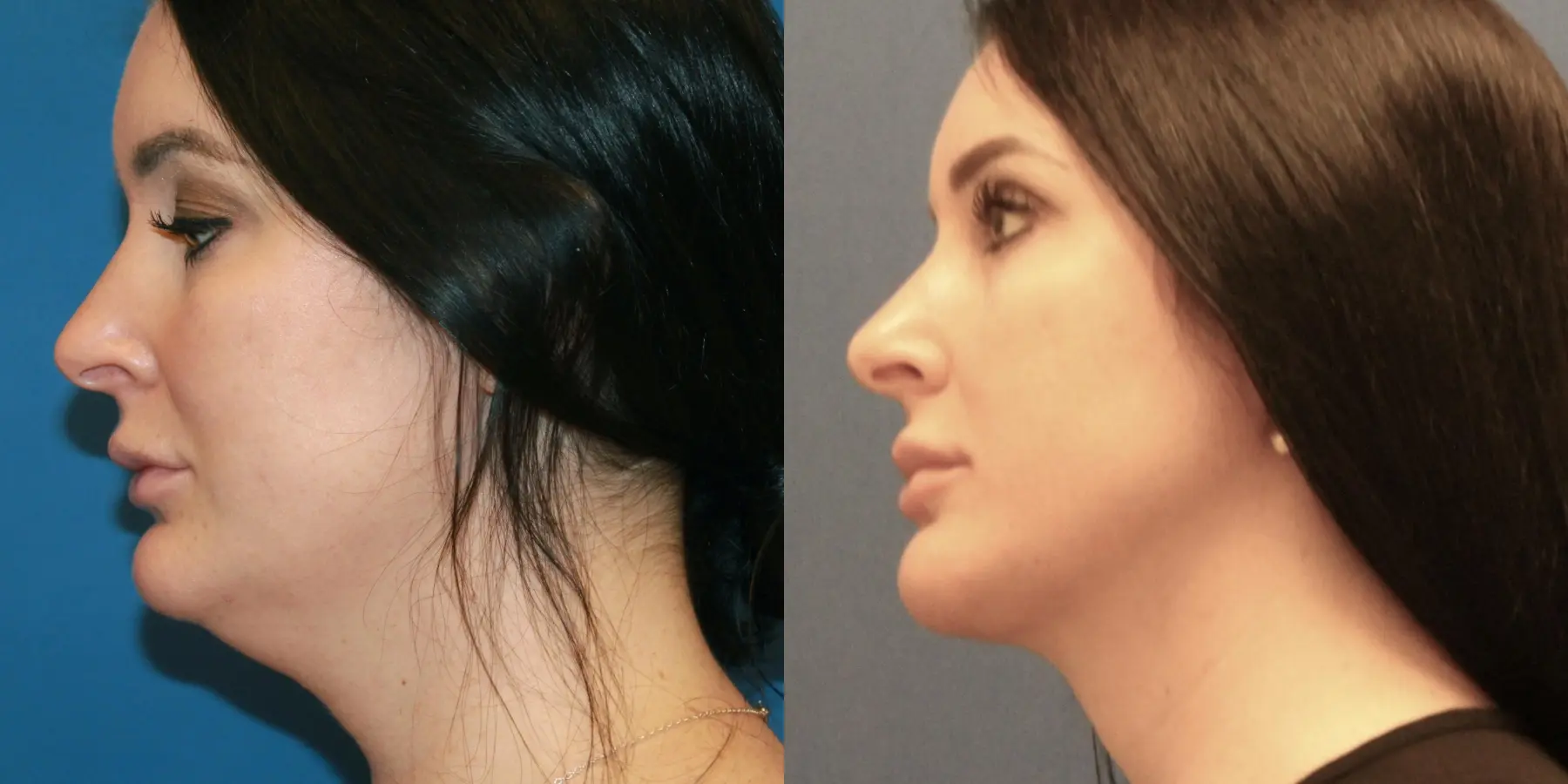 Renuvion Face: Patient 1 - Before and After 2