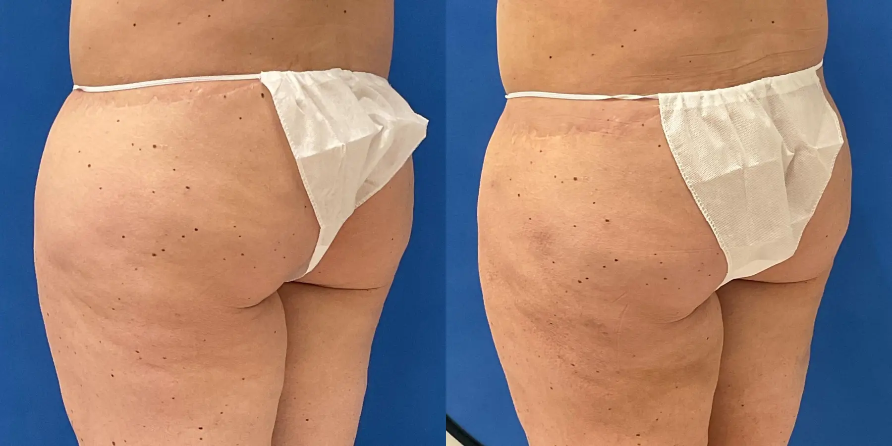 Skin Tightening: Patient 1 - Before and After 3