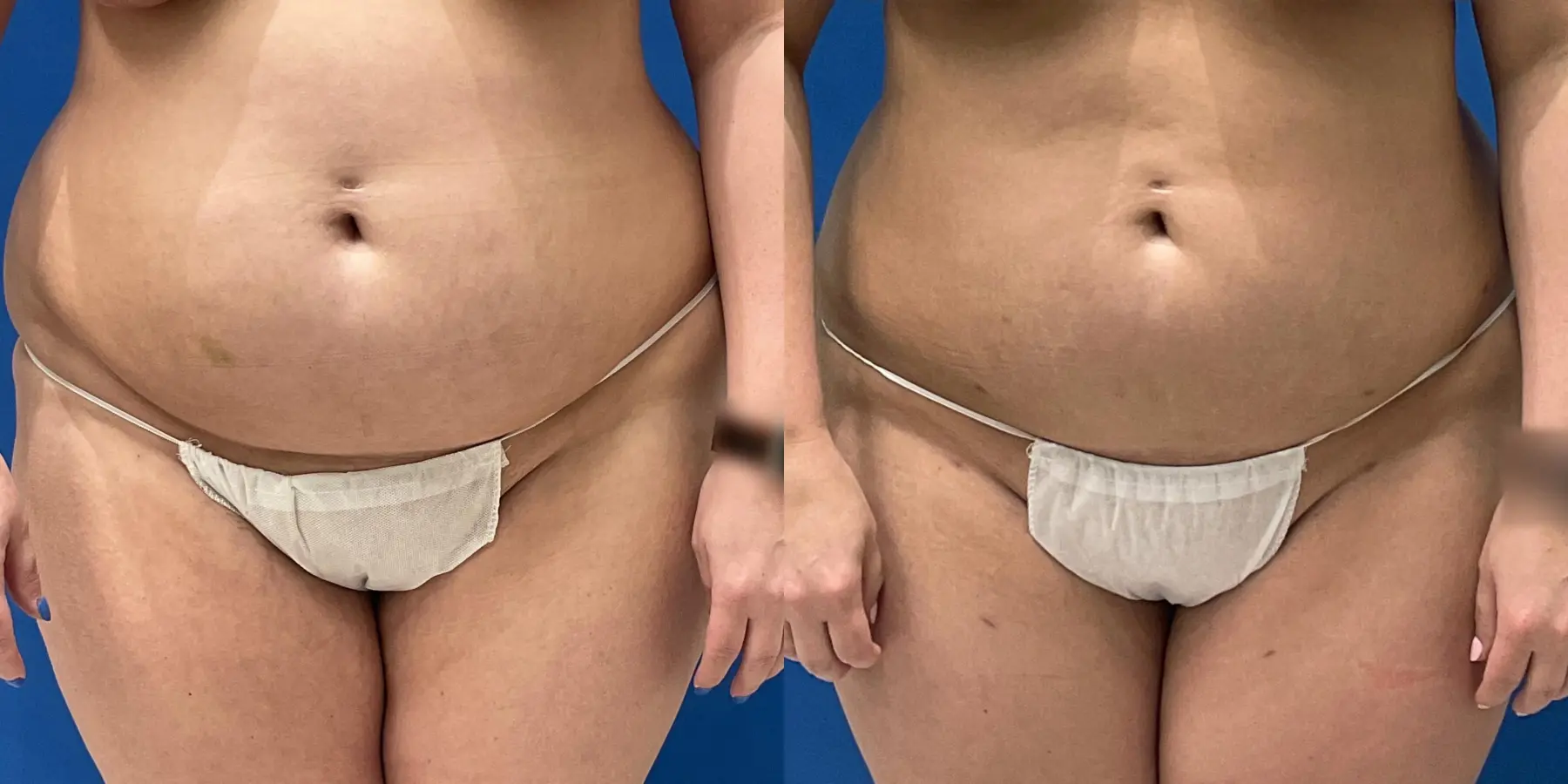 Skin Tightening: Patient 9 - Before and After  