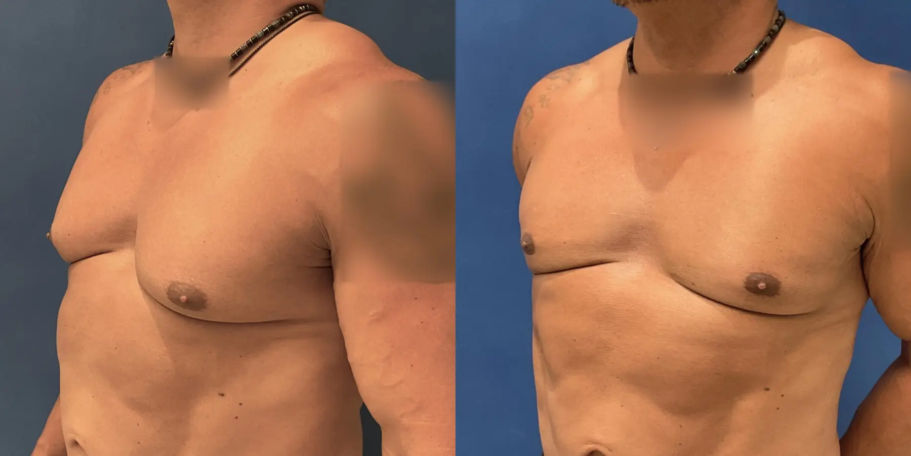 Skin Tightening For Men: Patient 6 - Before and After 2