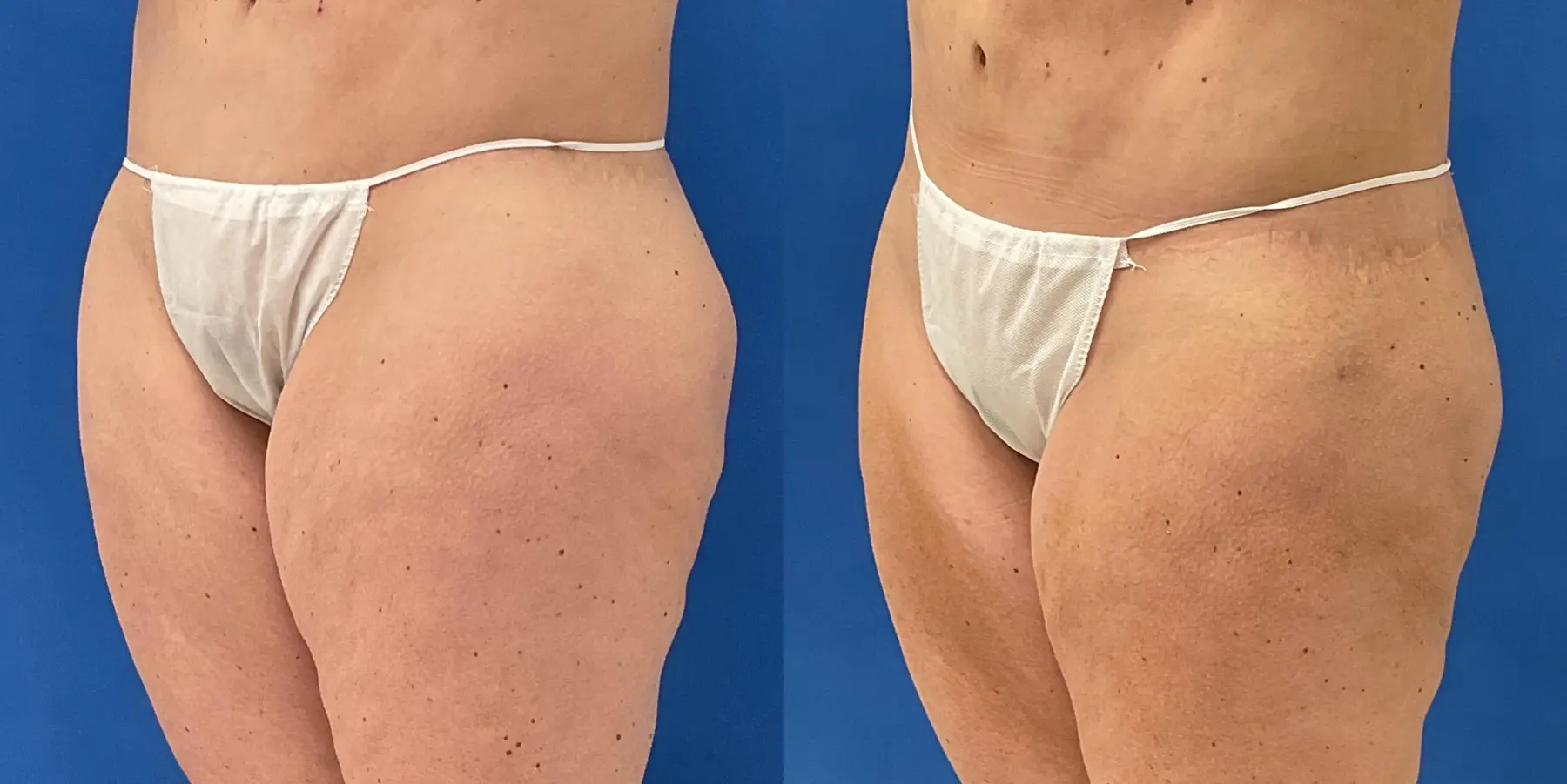 Skin Tightening: Patient 1 - Before and After 2