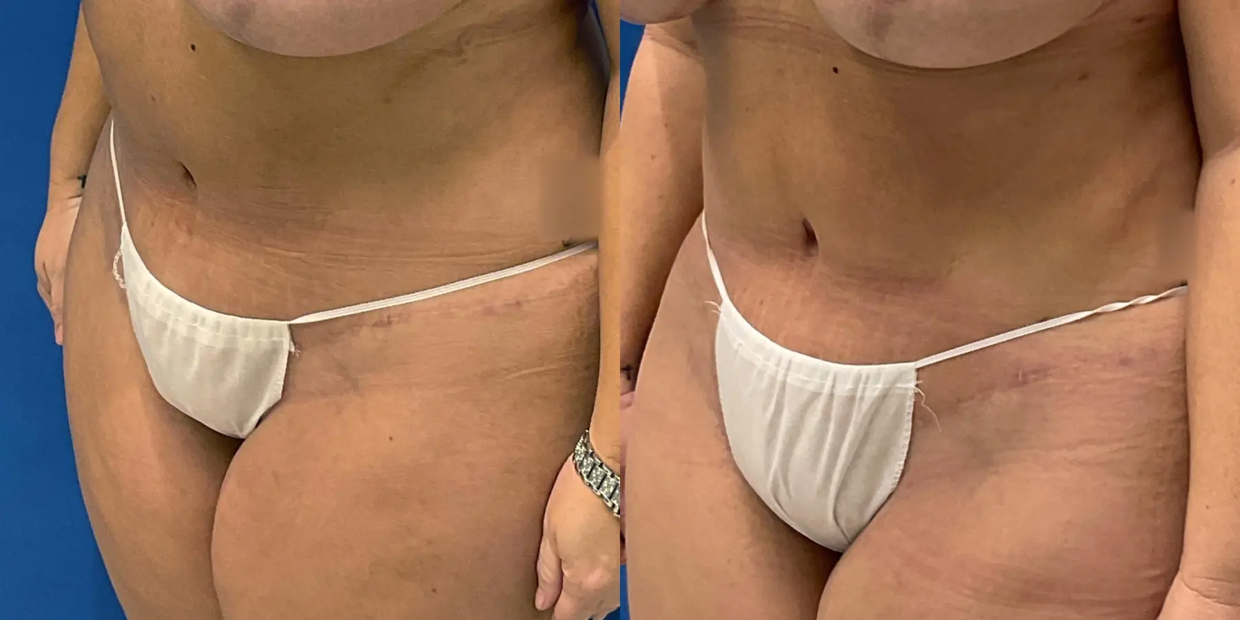 Skin Tightening: Patient 6 - Before and After 2