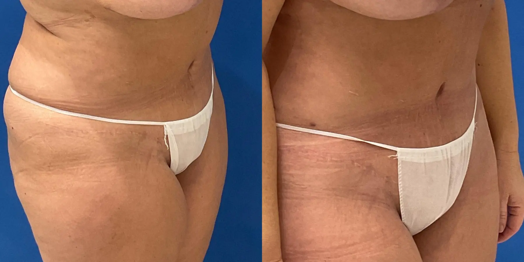 Skin Tightening: Patient 6 - Before and After 3