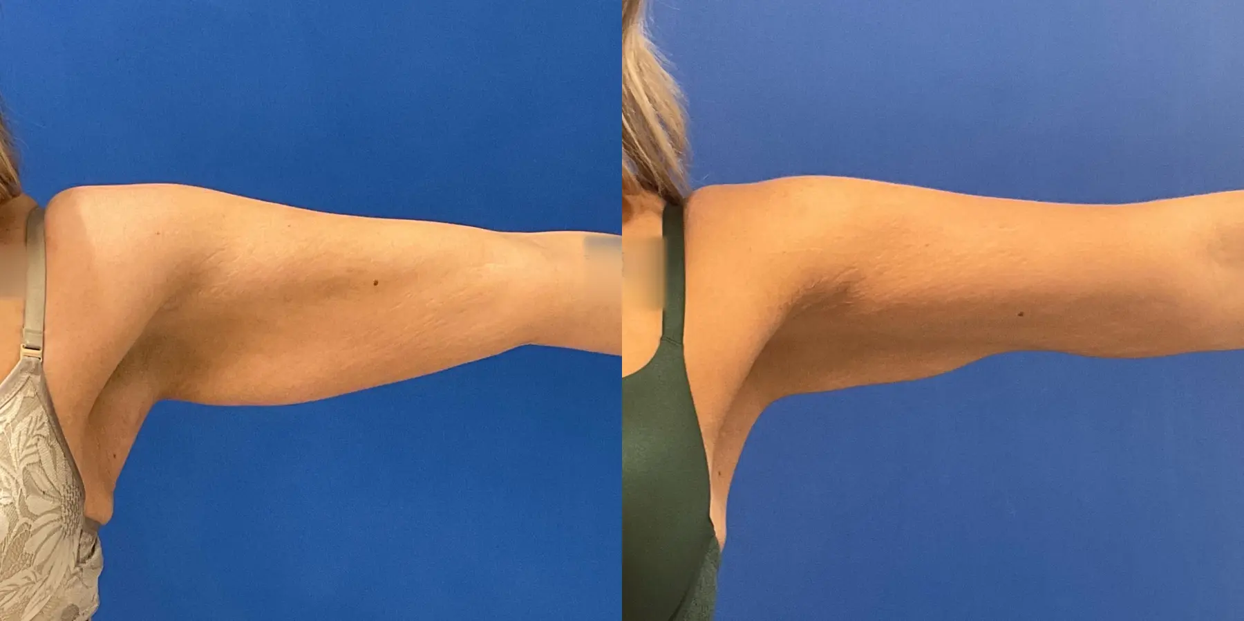 Skin Tightening: Patient 19 - Before and After 1