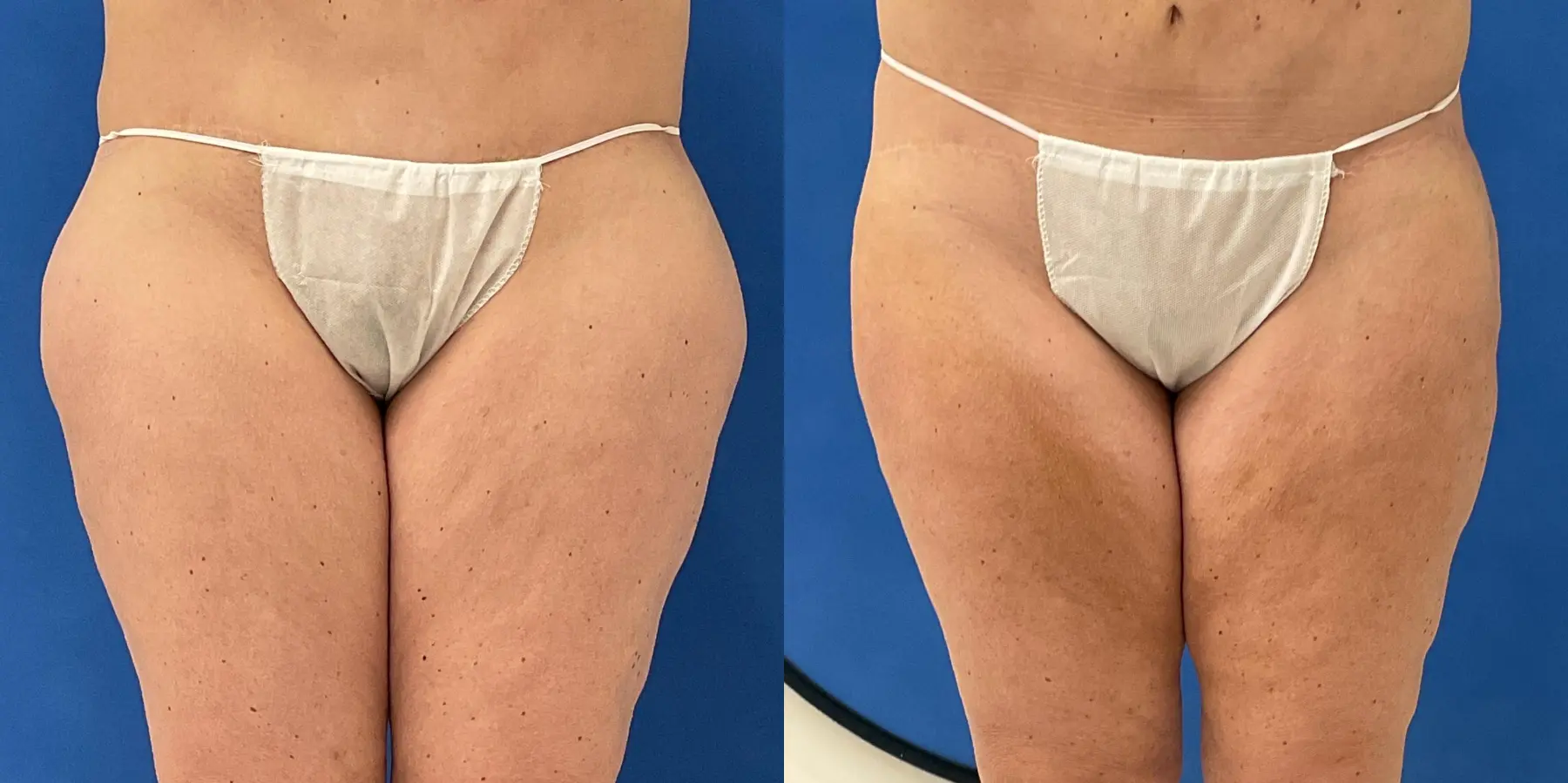 Skin Tightening: Patient 1 - Before and After 1