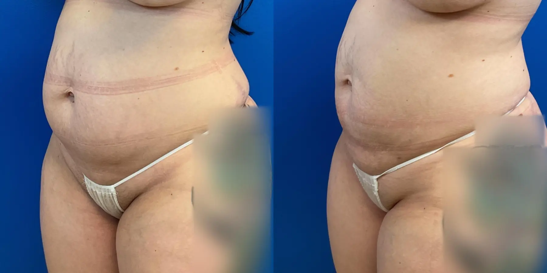 Skin Tightening: Patient 12 - Before and After 2