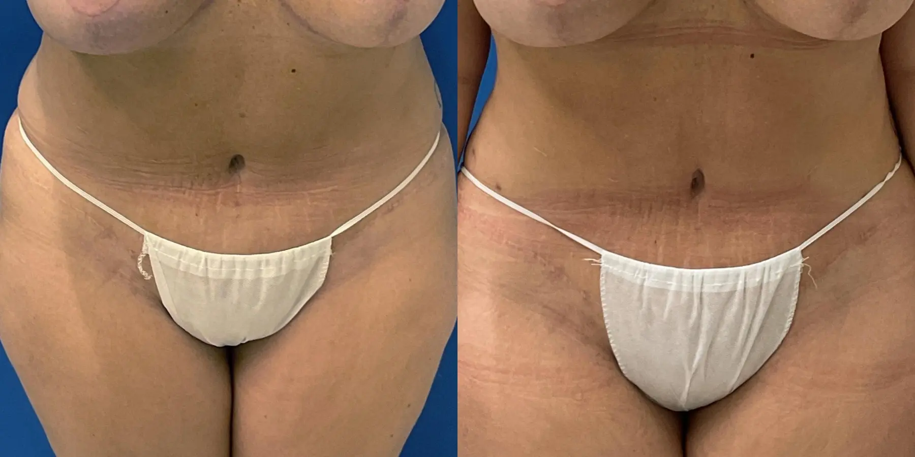 Skin Tightening: Patient 6 - Before and After 1