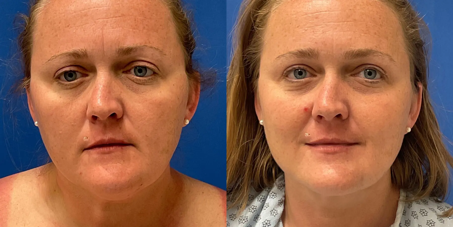 Skin Tightening Face: Patient 7 - Before and After 3