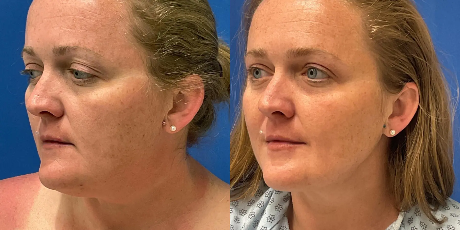 Skin Tightening Face: Patient 7 - Before and After 4