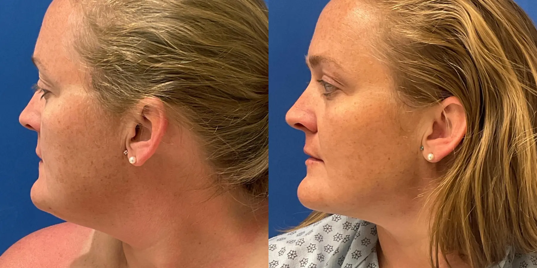 Skin Tightening Face: Patient 7 - Before and After 5