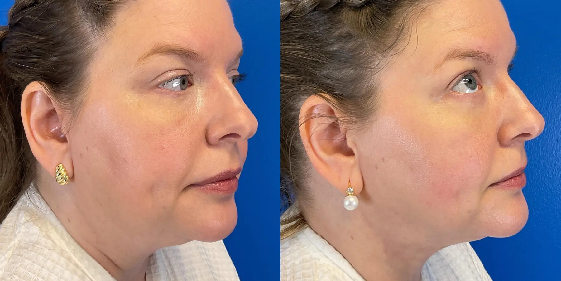 Skin Tightening Face: Patient 10 - Before and After 2