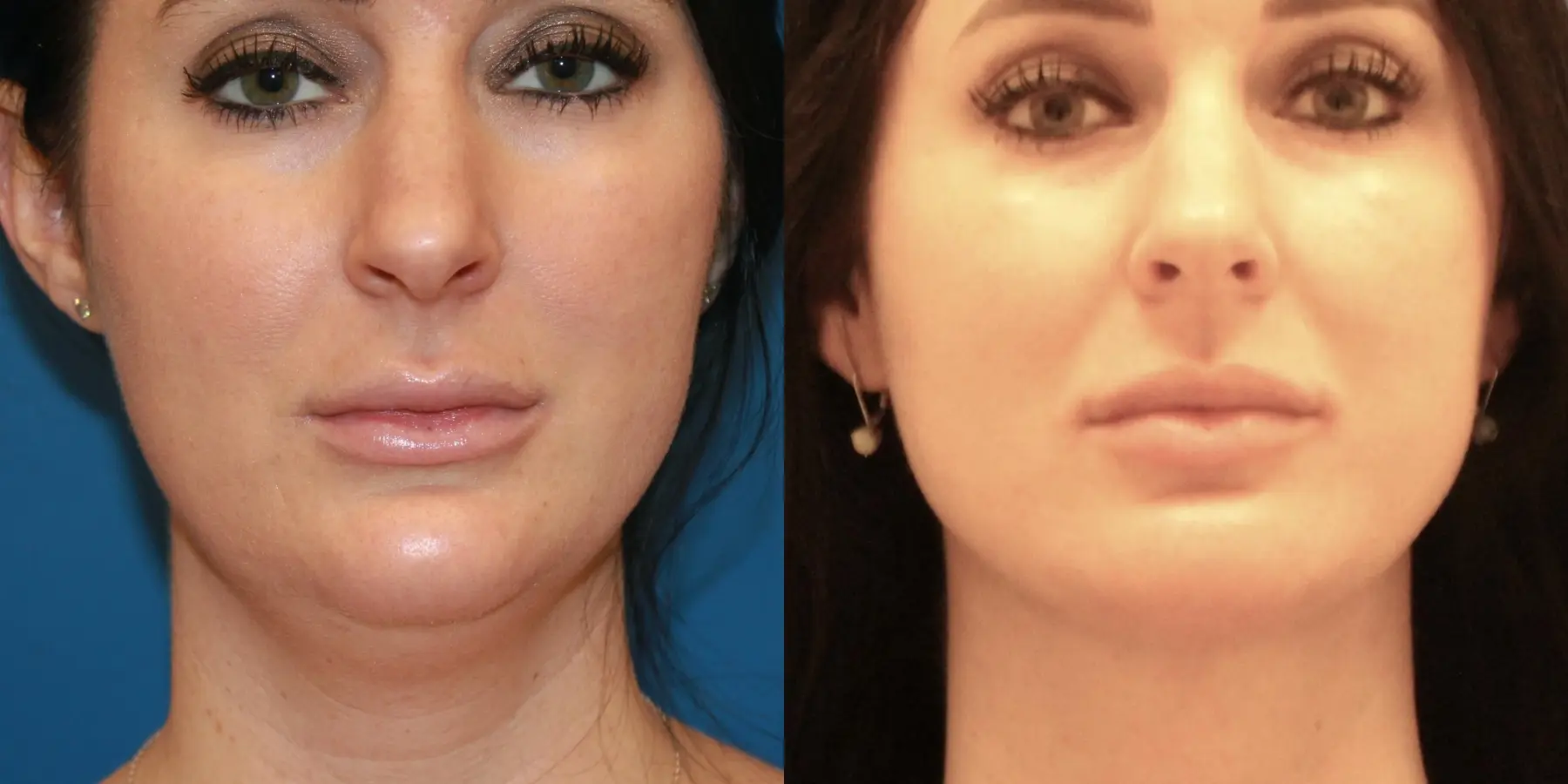 Skin Tightening Face: Patient 9 - Before and After 3