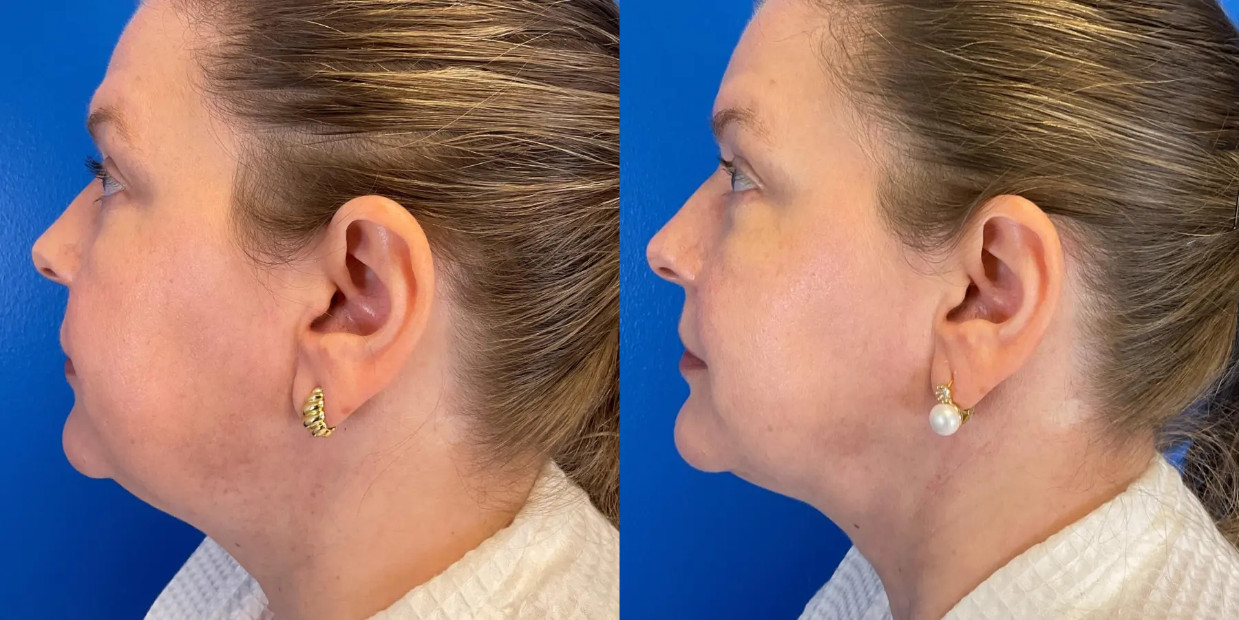 Skin Tightening Face: Patient 10 - Before and After 5