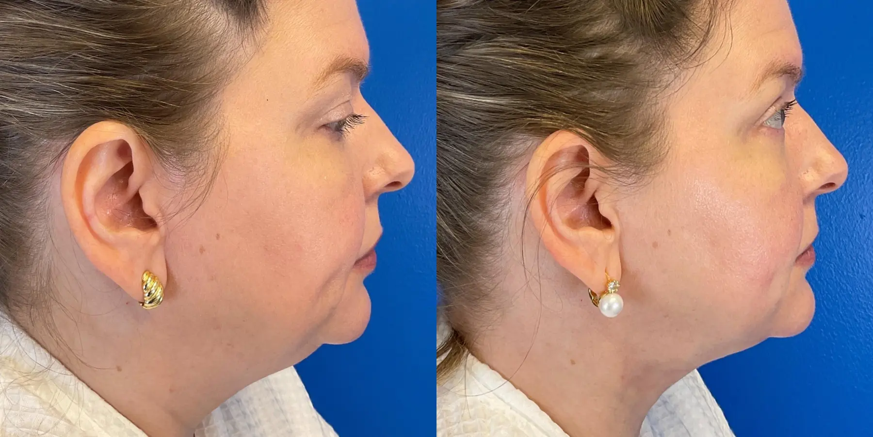 Skin Tightening Face: Patient 10 - Before and After 1