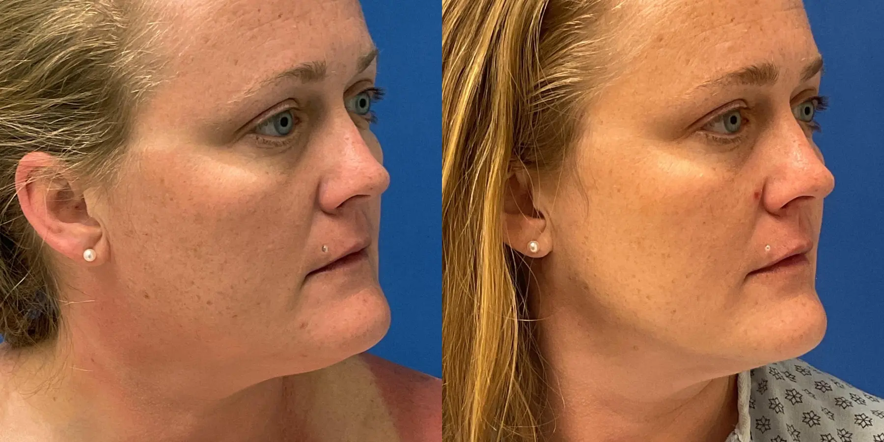 Skin Tightening Face: Patient 1 - Before and After 2