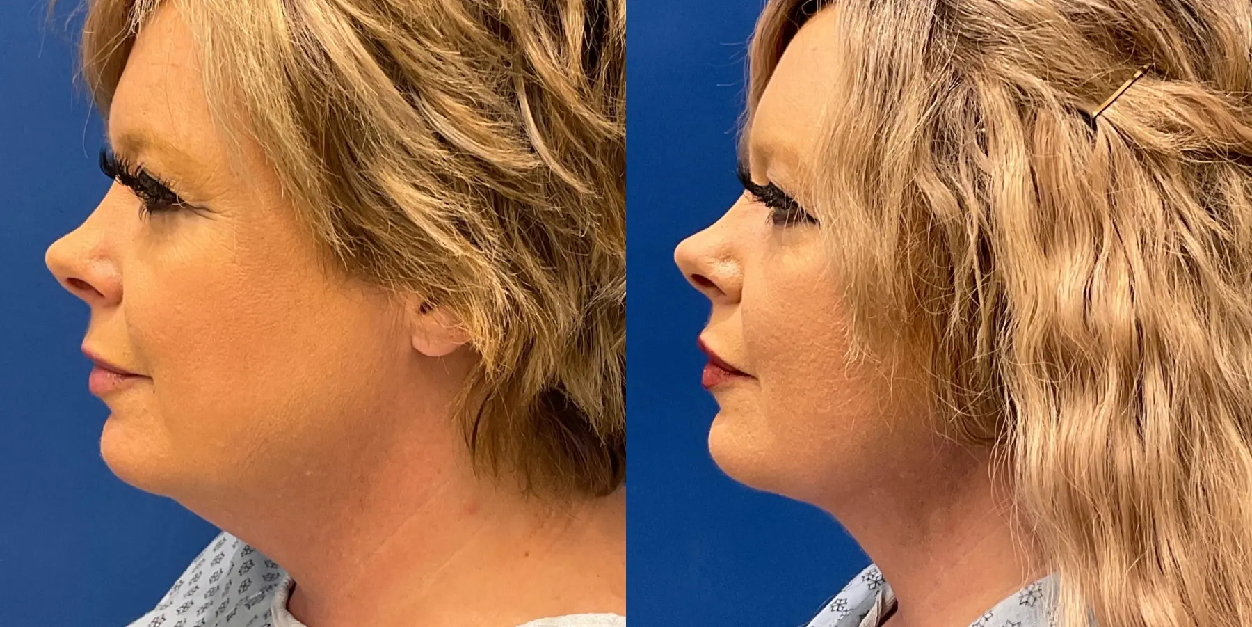 Skin Tightening Face: Patient 8 - Before and After 5