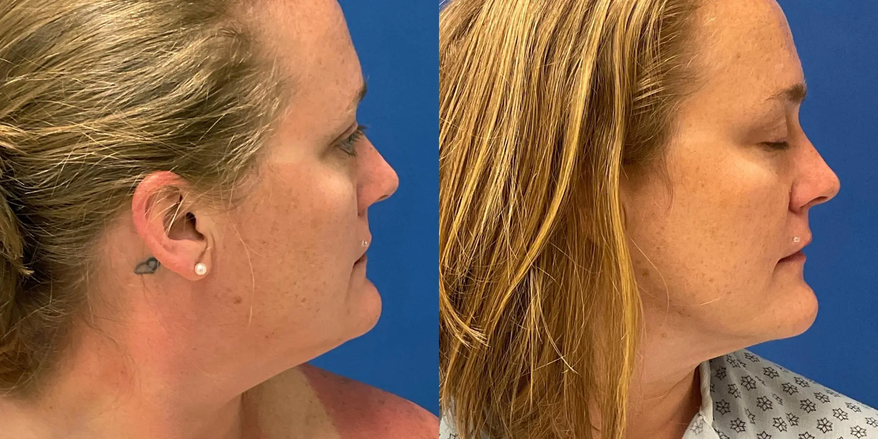 Skin Tightening Face: Patient 7 - Before and After 1