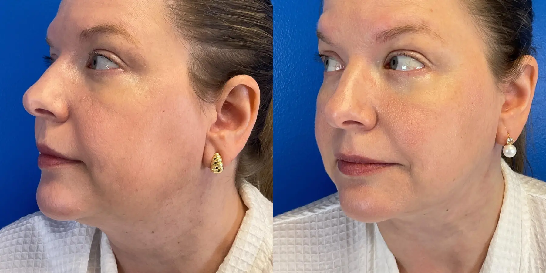 Skin Tightening Face: Patient 10 - Before and After 4