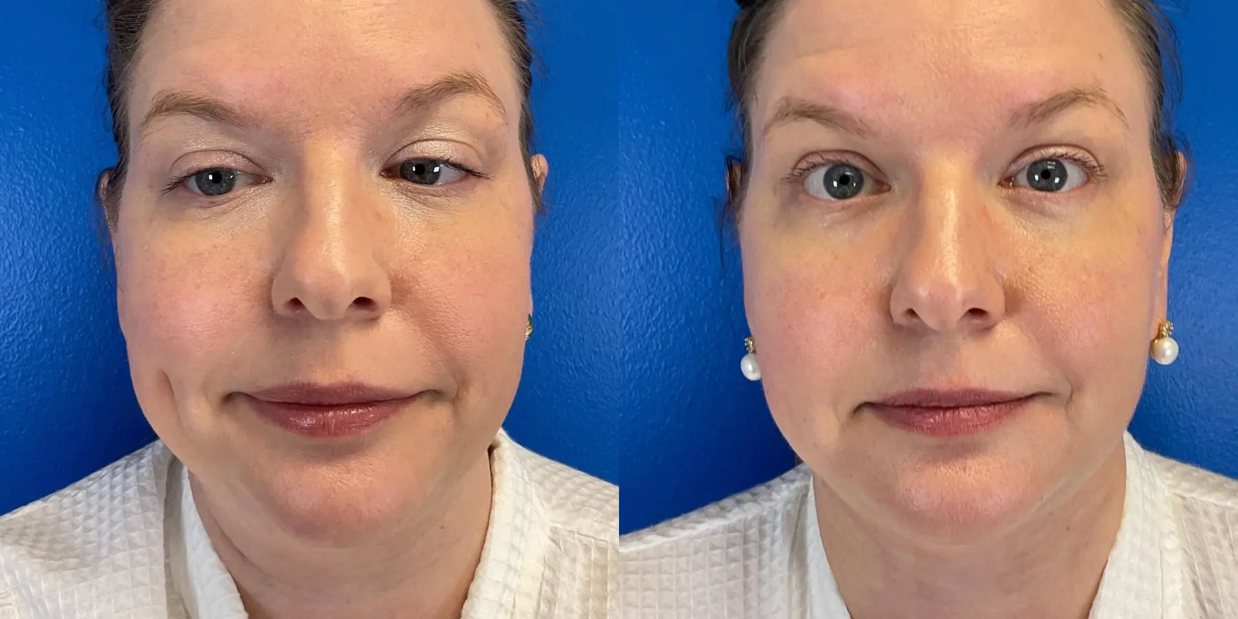 Skin Tightening Face: Patient 4 - Before and After 3