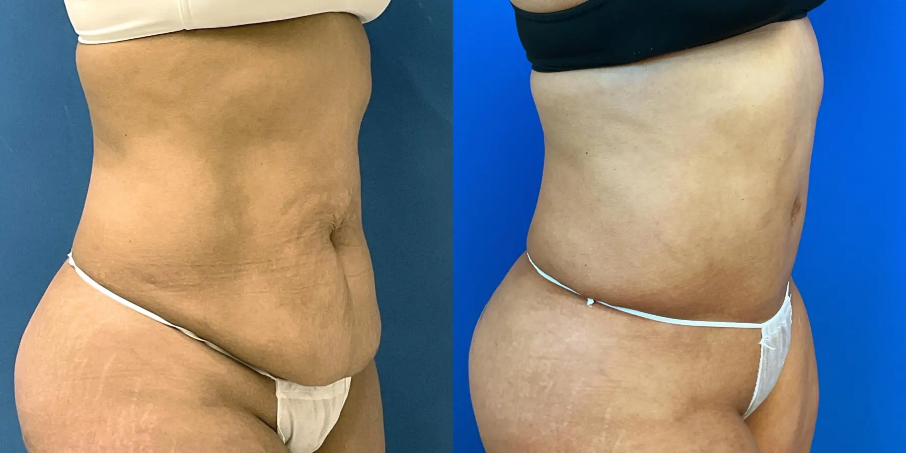 Tummy Tuck: Patient 25 - Before and After 3