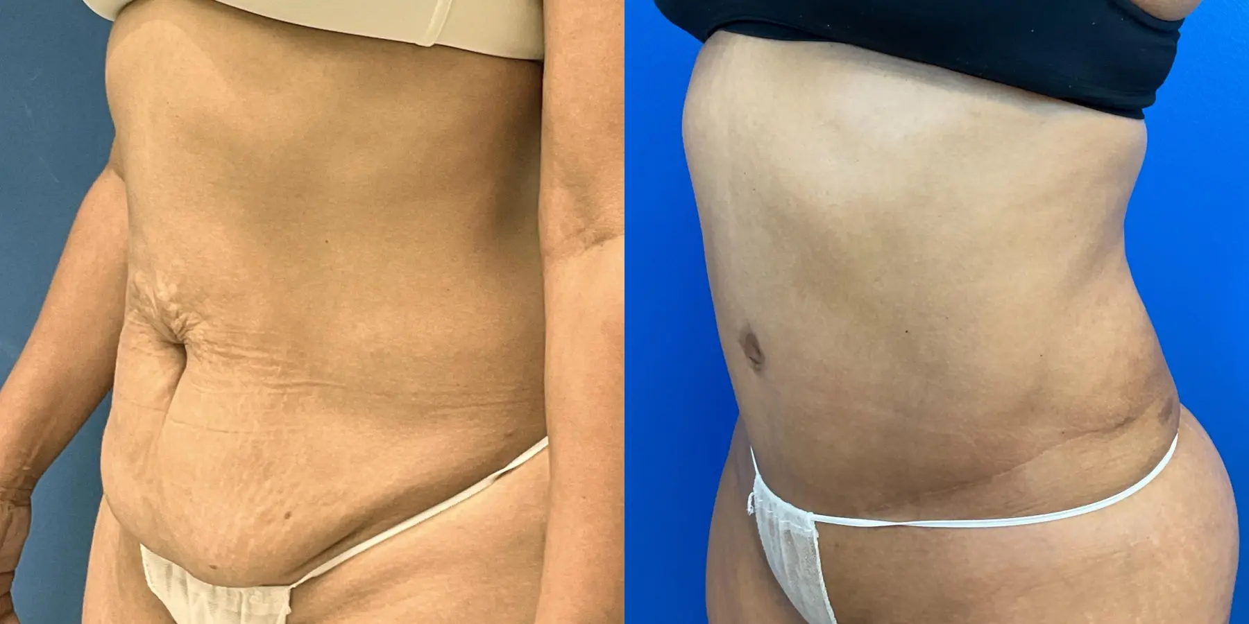 Tummy Tuck: Patient 3 - Before and After 2