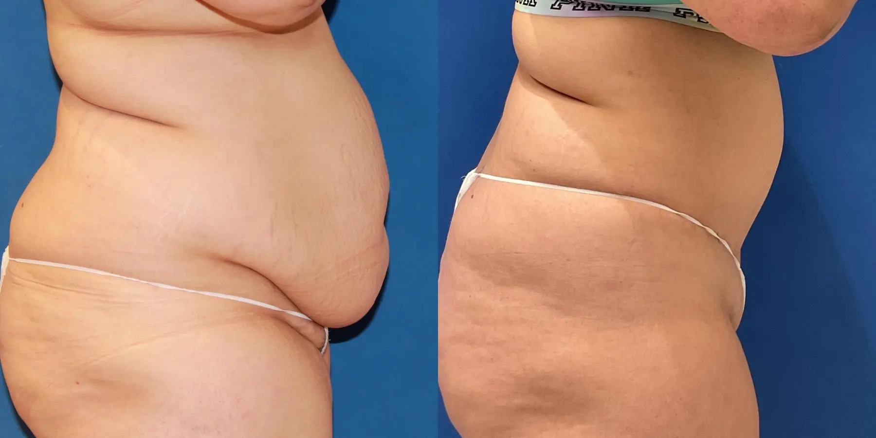 Tummy Tuck: Patient 9 - Before and After 3