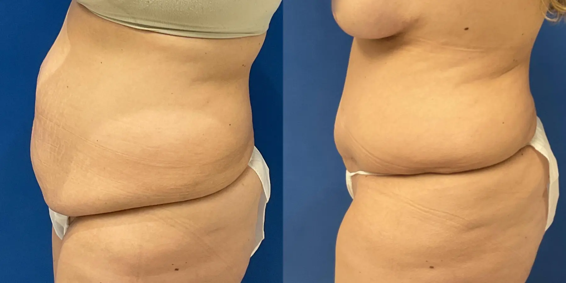 Tummy Tuck: Patient 6 - Before and After 4