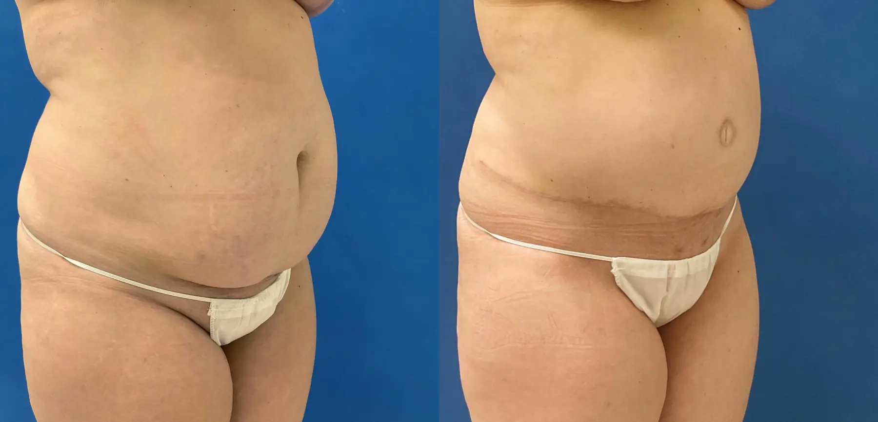 Tummy Tuck: Patient 4 - Before and After 3