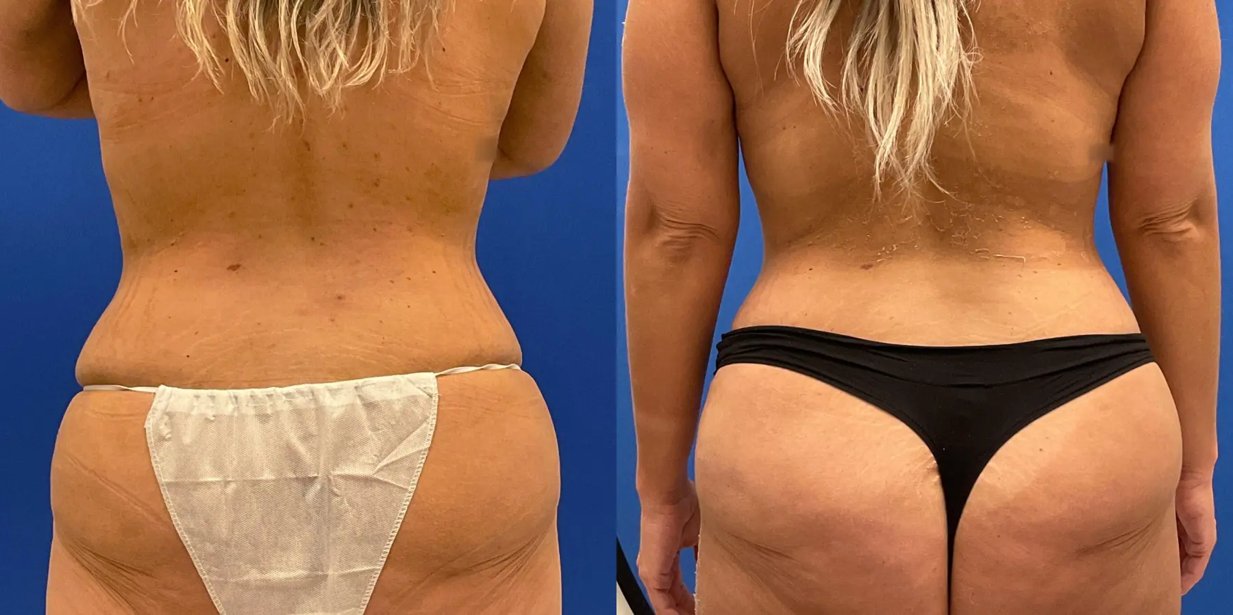 Tummy Tuck: Patient 13 - Before and After 6