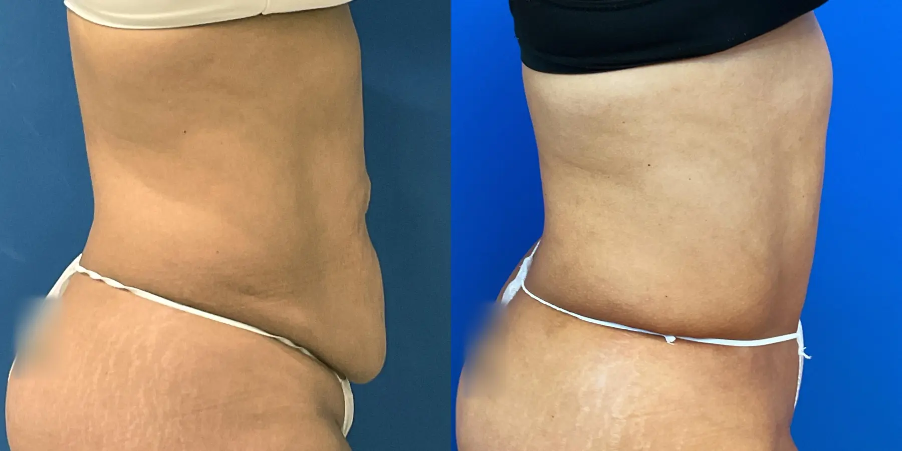 Tummy Tuck: Patient 3 - Before and After 5