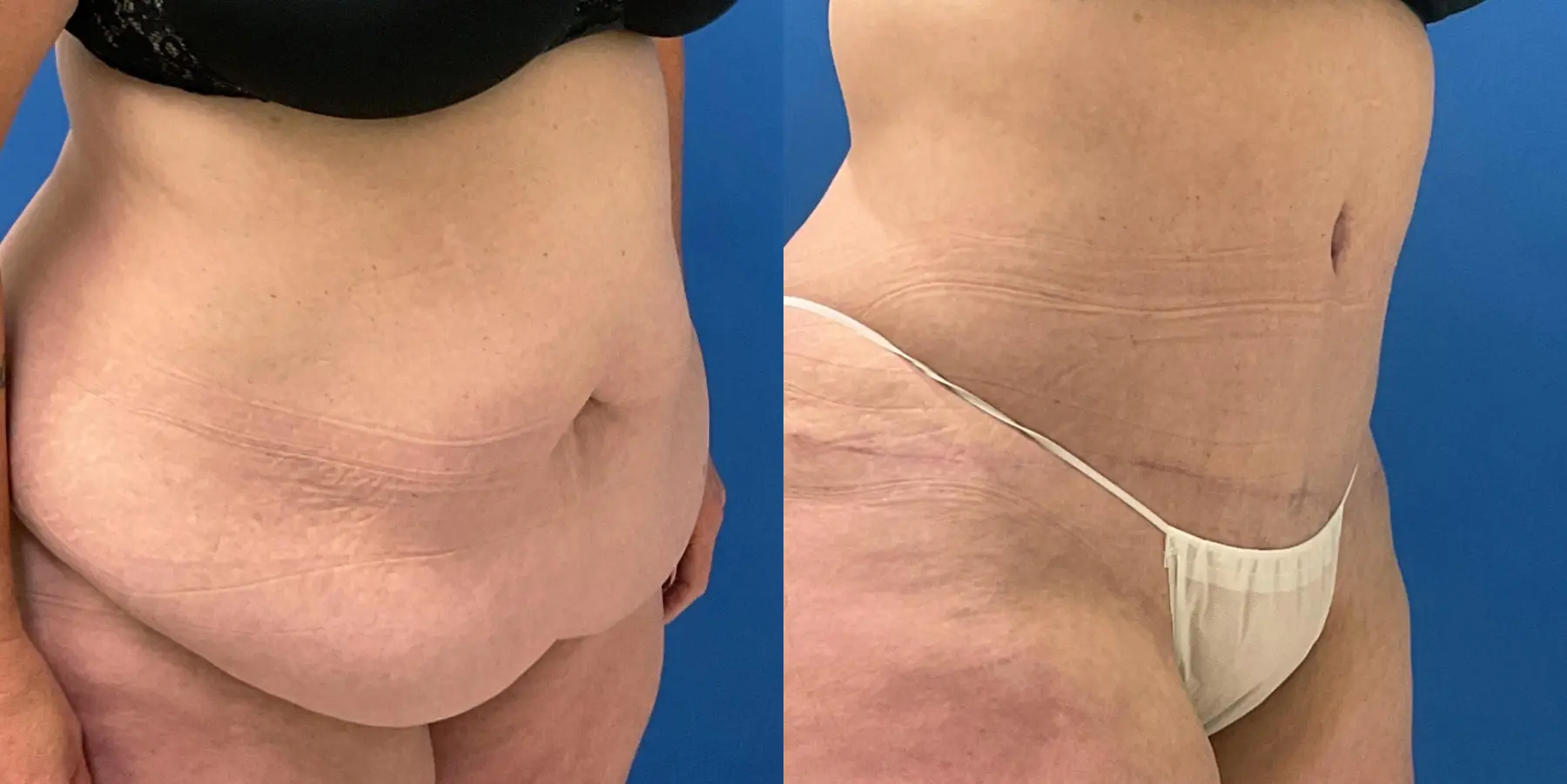 Tummy Tuck: Patient 1 - Before and After 3