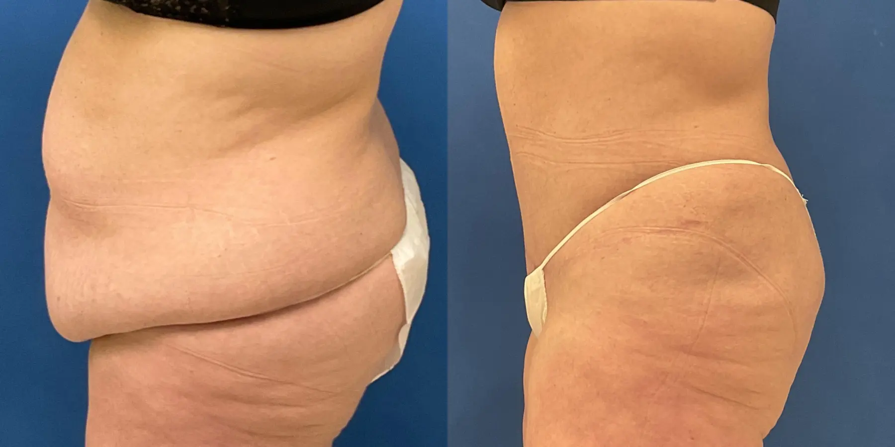 Tummy Tuck: Patient 1 - Before and After 4