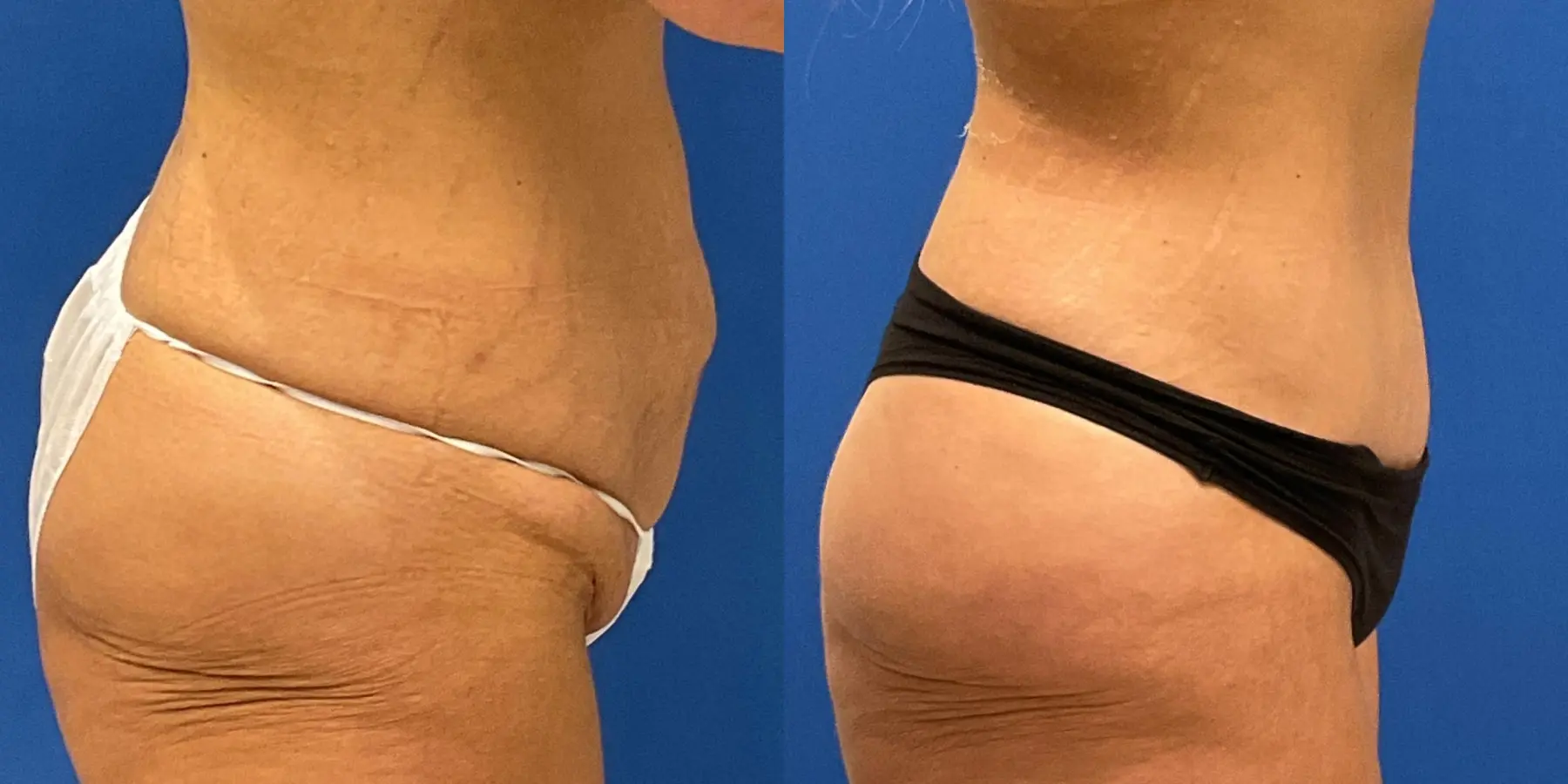 Tummy Tuck: Patient 13 - Before and After 5