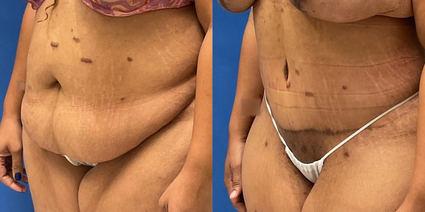 Tummy Tuck: Patient 7 - Before and After 2