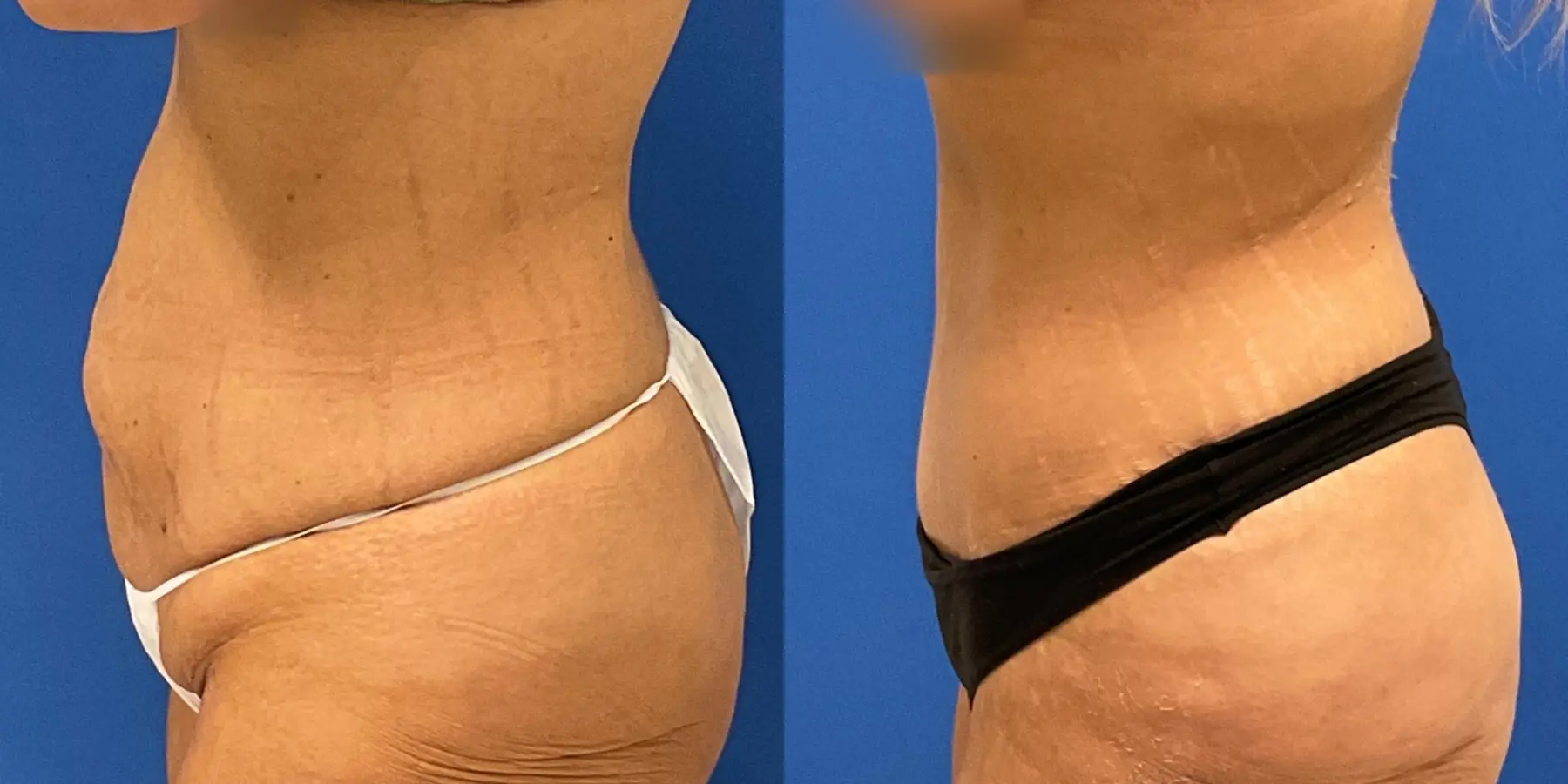 Tummy Tuck: Patient 13 - Before and After 4