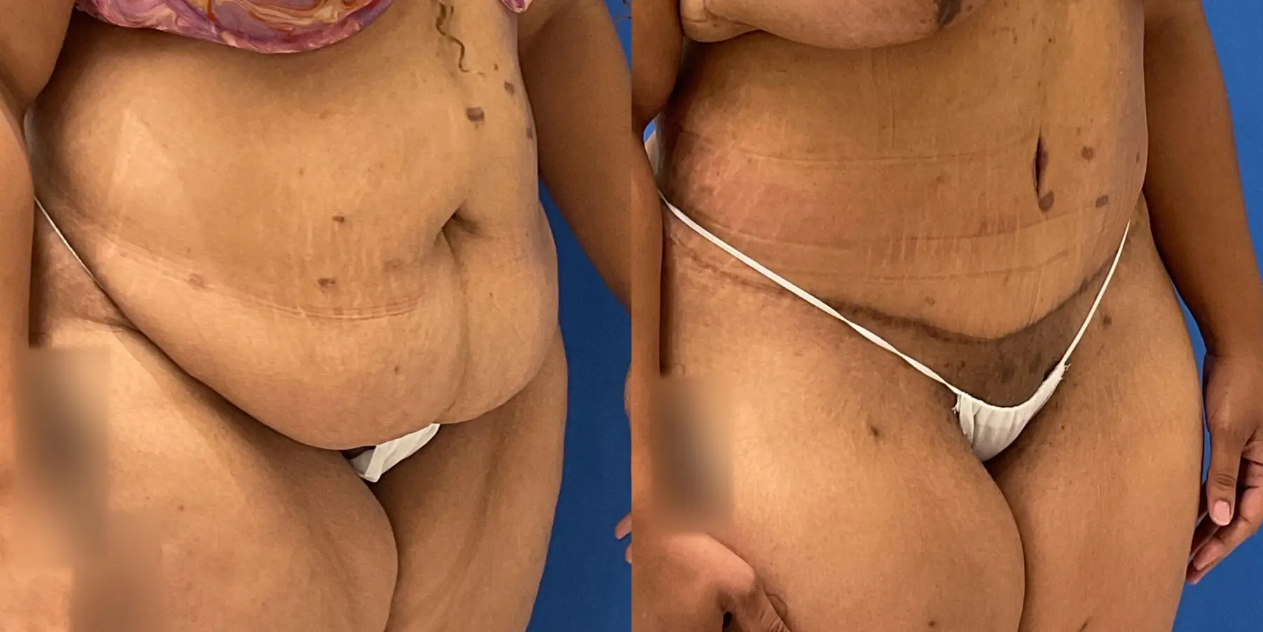 Tummy Tuck: Patient 7 - Before and After 3